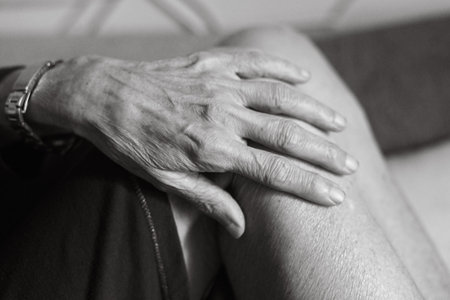 80 year old woman hands with osteoarthritis, swollen hands and fingers, joint inflammation, due to...