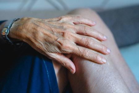 80 year old woman hands with osteoarthritis, swollen hands and fingers, joint inflammation, due to lack of cartilage of body deterioration compensation.の写真素材