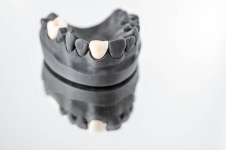 Close-up on plaster model of painted in black artificial jaw with implant crown on the mirror background. Concept of aesthetic dentistry and implantationの写真素材