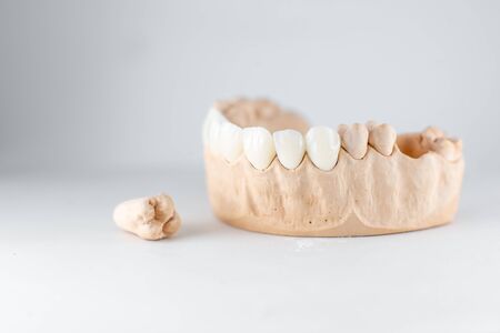 Close-up on plaster model of artificial jaw with veneers and tooth on the white background. Concept of prosthetics and implantation in dentistryの写真素材