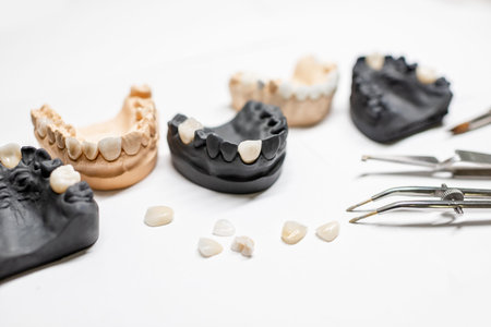 Artificial plaster jaw models with implants, veneers and dental instruments on the white background....