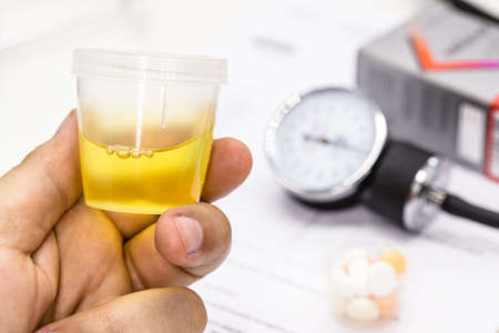 hand holding urine pot or bottle, delivering urine for medical examination for hypertension diagnosisの写真素材
