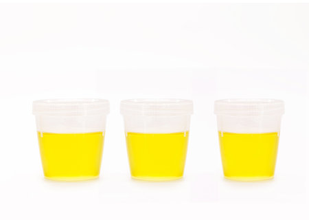 collection bottle with urine, urinalysis EAS - Abnormal Sediment Elements, serves to analyze the pH...