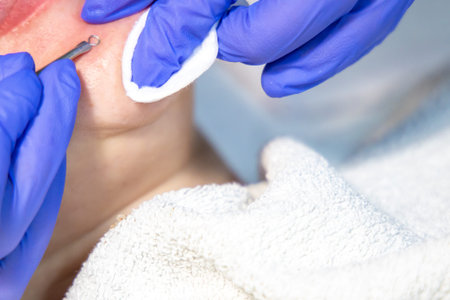 Hardware face cleaning procedure with special treatment. Beautiful woman in a beauty salon....