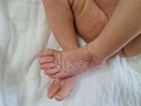 Newborn baby feet with flaky dry skin. Infant after born with very dry, wrinkled, cracked skin on footの写真素材