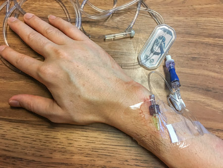 infusion