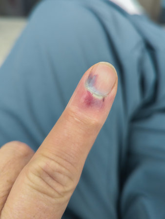 Badly smashed finger tip of mans handの写真素材