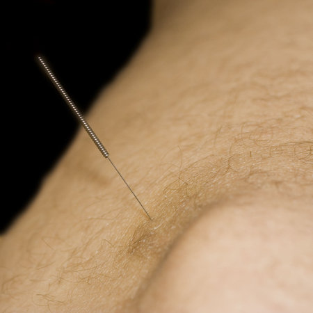Man with acupuncture needle in leg - close-up 