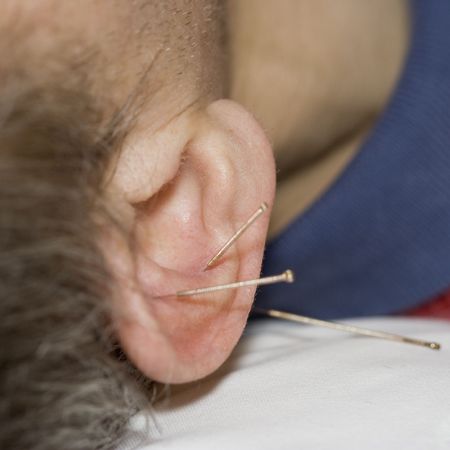 Man with acupuncture needles in his ear - close-upの写真素材