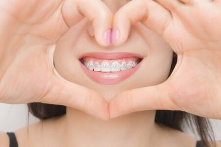 Dental braces in happy womans mouths through the heart. Brackets on the teeth after whitening....