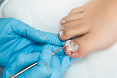 Podologist professional wearing blue gloves performs antifungal treatment on a womans toes in medical center.の写真素材