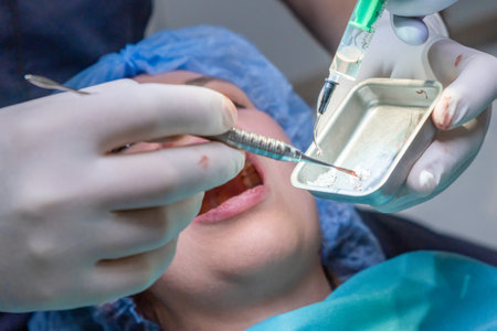 Dental team applies bone graft material into patient mouth during procedure. Instruments and suction tool assist in precise placement of materialの写真素材