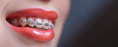 Close-up of a woman's mouth with braces. Copy space for advertisement or textの素材