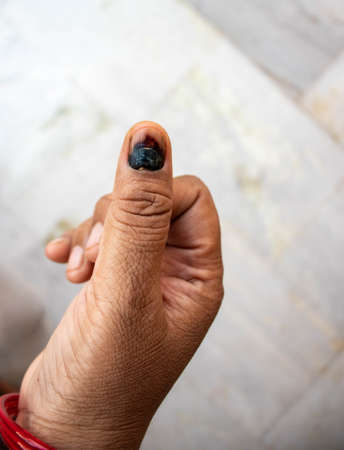 Close up of thum nail become black after Injury.