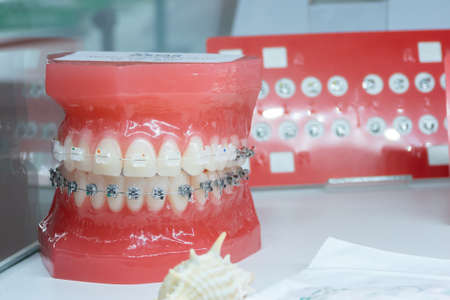 MOSCOW, RUSSIA - SEP 27, 2018. Dental bracket system on exhibitionのeditorial素材