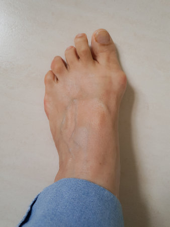 A woman's foot, resting on the ground, showing her nails trimmed and with ringworm at the corners of...