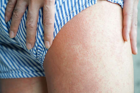 Close up Allergy rash, round view of the hind thighs of an Asian man with the disease. Allergy rash...