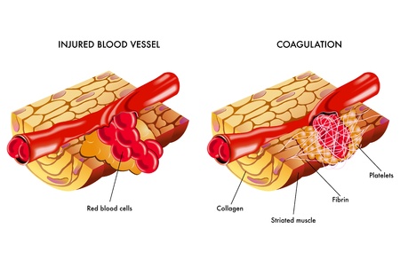 Blood coagulationのイラスト素材