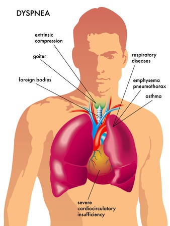 dyspneaのイラスト素材