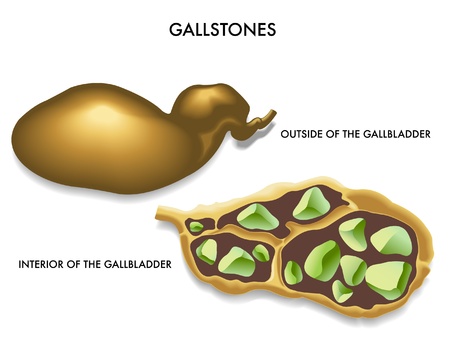 gallstonesのイラスト素材