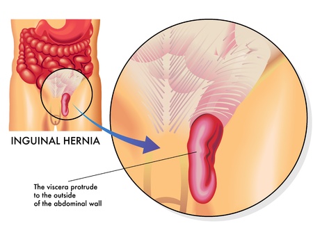 inguinal herniaのイラスト素材