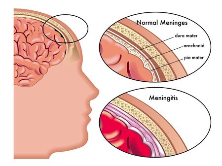 Meningitisのイラスト素材