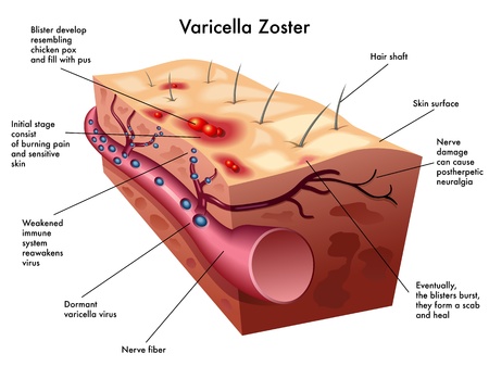 varicella zoster virusのイラスト素材