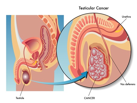 Testicular cancerのイラスト素材