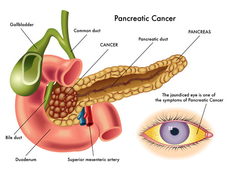 pancreatic cancerのイラスト素材