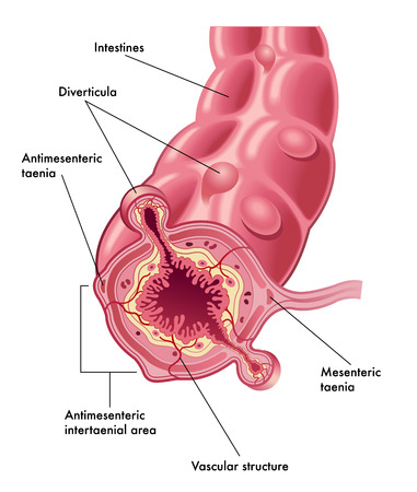 diverticulaのイラスト素材