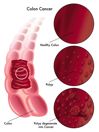 colon cancerのイラスト素材