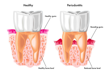 periodontitisのイラスト素材