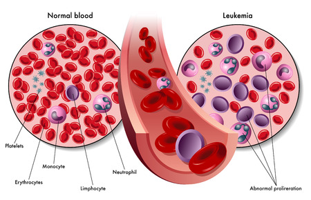 leukemiaのイラスト素材