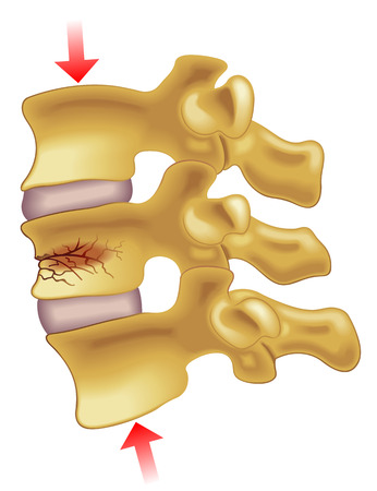 vertebral compression fractureのイラスト素材