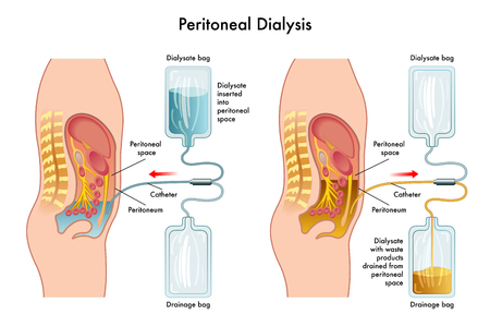 peritoneal Dialysisのイラスト素材