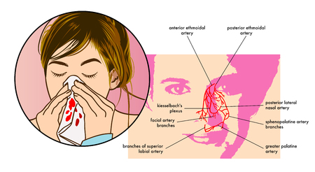 Symptoms of epistaxisのイラスト素材