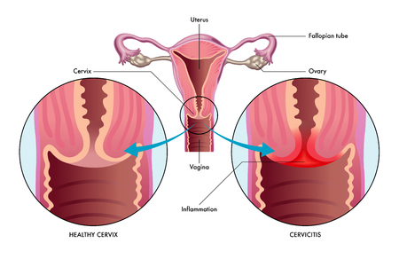 vector medical illustration of the condition cervicitis showing healthy cervix versus one with inflammationのイラスト素材