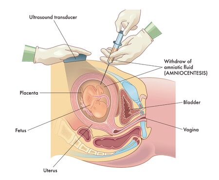 Medical illustration of Amniocentesis procedure with annotations.のイラスト素材