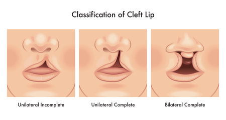 Medical illustration shows a classification of cleft lip, with annotations.のイラスト素材