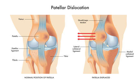 Medical illustration of symptoms of patellar dislocation, with annotations.のイラスト素材