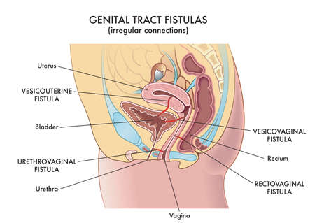 Medical illustration of the irregular connections called fistulas that can be found in the woman's genital tract.のイラスト素材