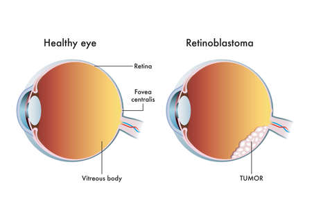 Medical illustration compares a healthy eye with one affected by retinoblastoma.のイラスト素材