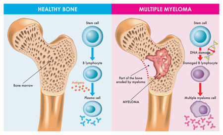 Medical illustration shows the difference between healthy bone and one that is eroded by multiple myeloma, which is caused by damaged DNA.のイラスト素材