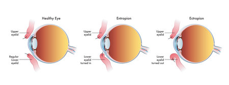 Medical illustration shows the comparison between a normal eye, one affected by entropion and another affected by ectropion.のイラスト素材