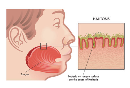 Medical illustration of the cause of Halitosisのイラスト素材