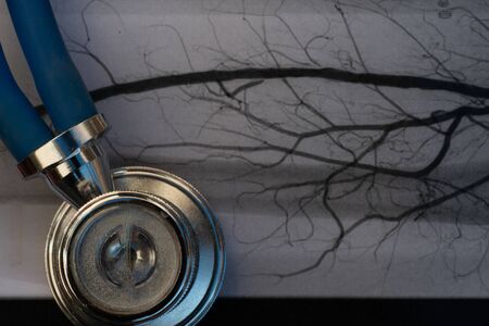 Stethoscope on medical image of arterys in the leg.cholesterol blocked artery ,smoking.