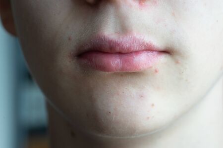 teenage boy withachnÃ© spots and dry lips.close up.skin care.