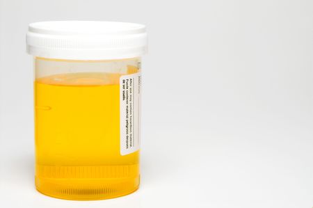A fresh urine sample in a medical container.
