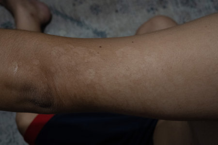 Close-up of men's arm with dry skin on it with the disease tinea versicolorの写真素材