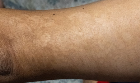 Close-up of men's arm with dry skin on it with the disease tinea versicolorの写真素材